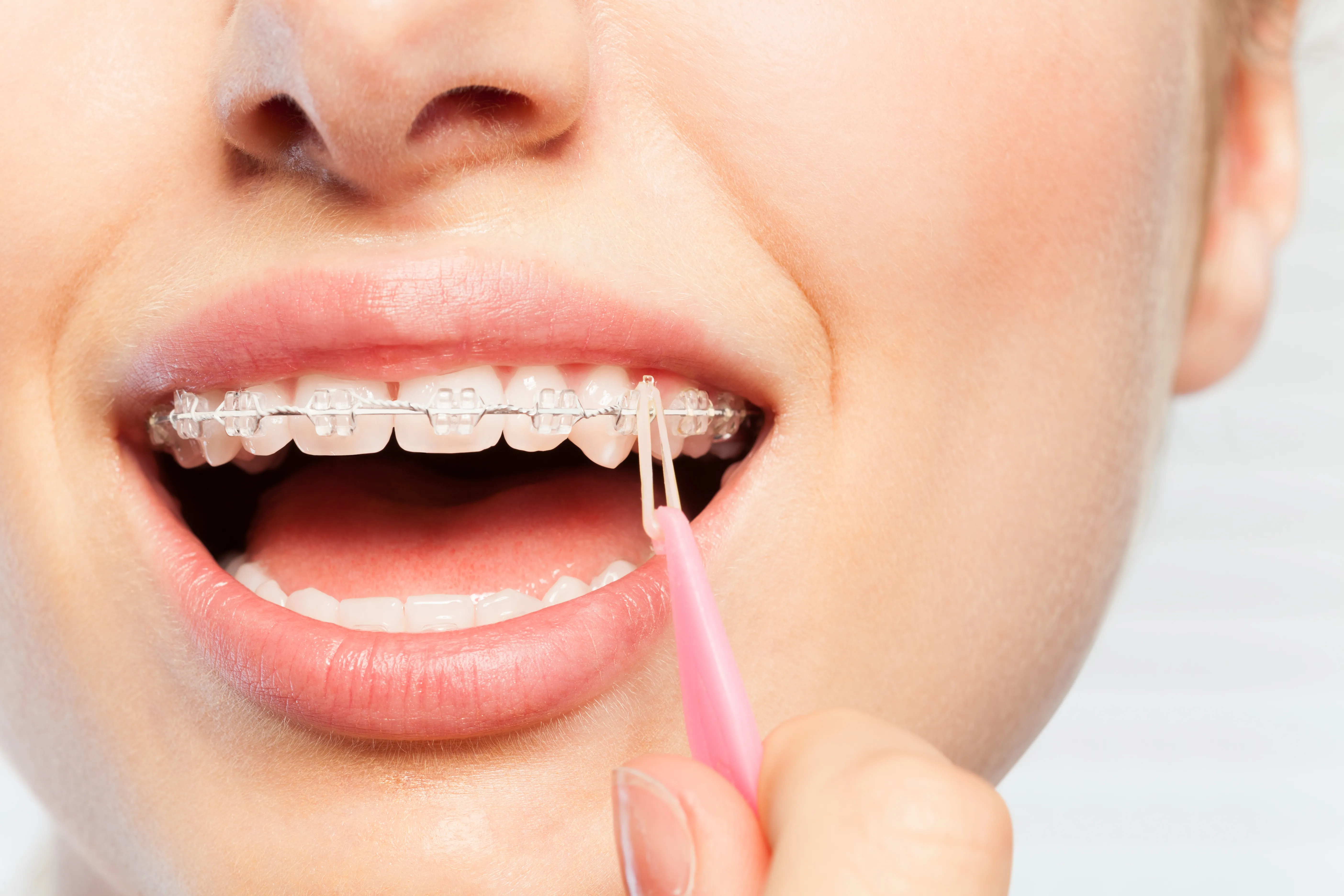 Orthodontiste Tarbes 65000 bagues élastiques