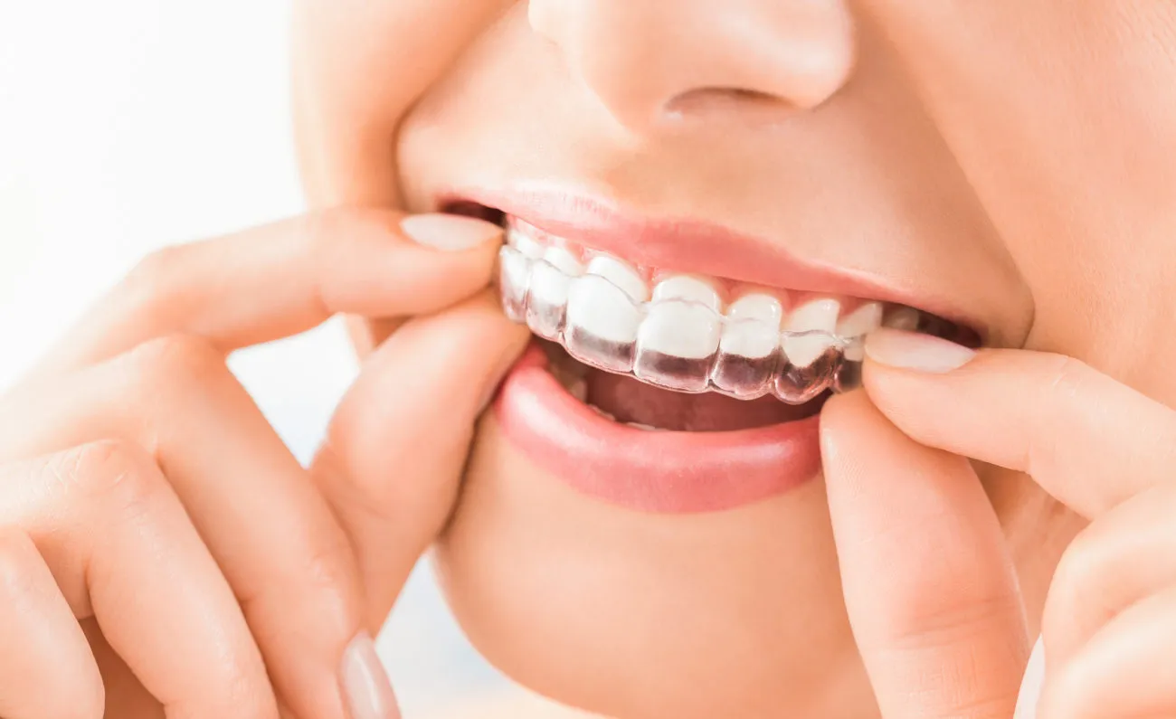 Orthodontiste adulte Tarbes 65000 Aligneurs