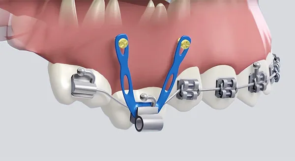Orthodontiste adolescent Tarbes 65000 minivis