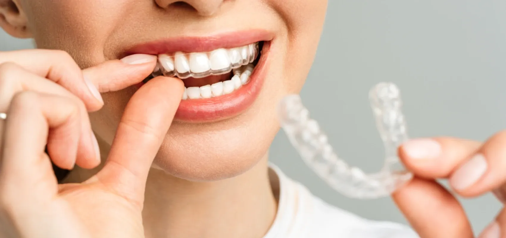 Orthodontiste adultes Bagn&egrave;res-de-Bigorre