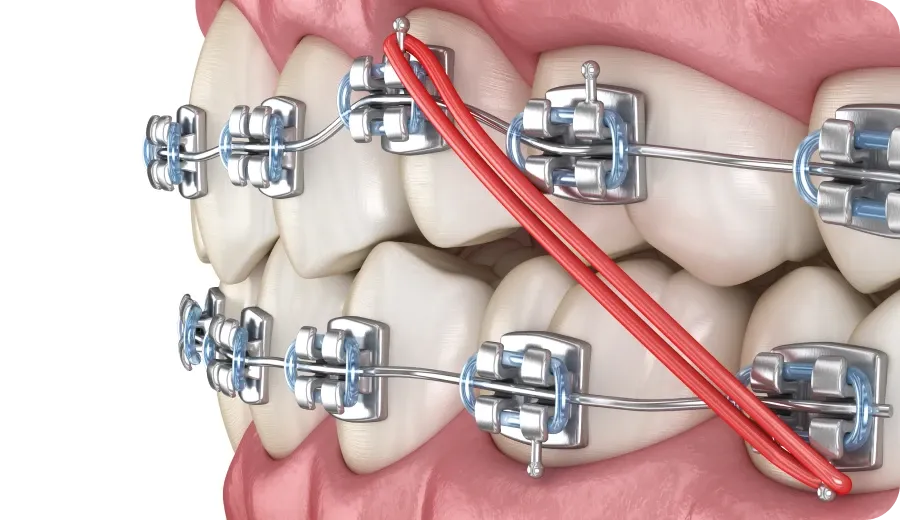 Orthodontiste Tarbes 65000 bagues élastiques