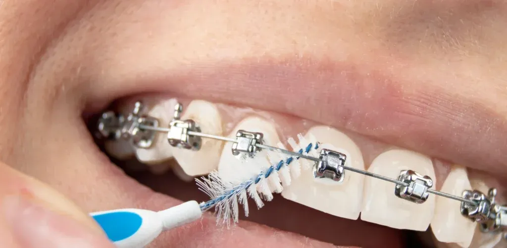 Orthodontiste Tarbes 65000 bagues élastiques
