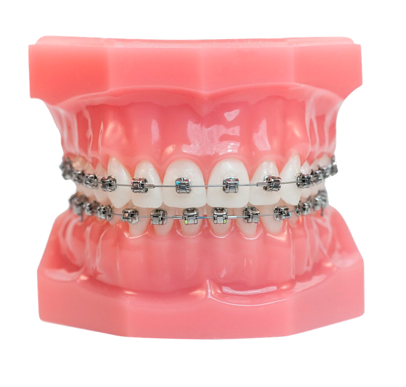Orthodontiste Tarbes 65000 bagues