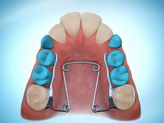 Orthodontiste enfants Tarbes 65000 Quad-helix